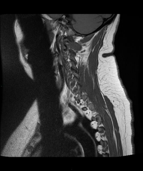 File:Cervical disc prolapse (Radiopaedia 80258-93598 Sagittal T1 15).jpg