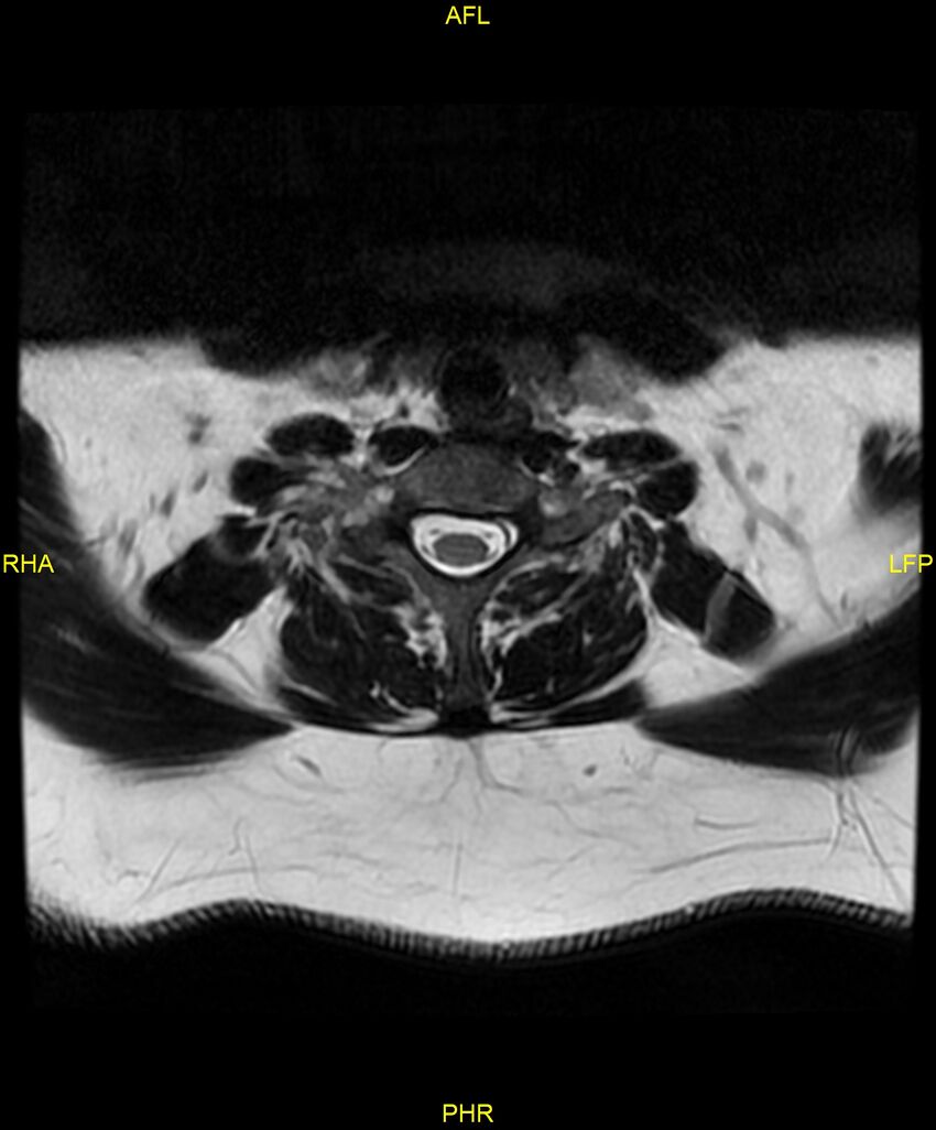 Cervical disc protrusion (Radiopaedia 87147-103415 Axial T2 57).jpg