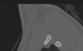 Cervical disc replacement (Radiopaedia 37383-39205 Sagittal bone window 74).png