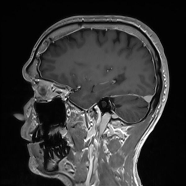 File:Cervical dural CSF leak on MRI and CT treated by blood patch (Radiopaedia 49748-54995 G 28).jpg