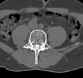 Cervical dural CSF leak on MRI and CT treated by blood patch (Radiopaedia 49748-54996 B 109).png