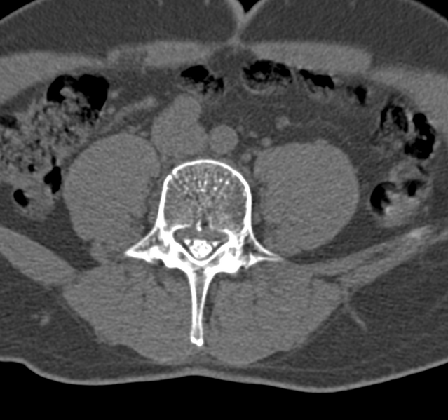 File:Cervical dural CSF leak on MRI and CT treated by blood patch (Radiopaedia 49748-54996 B 109).png