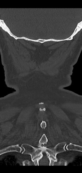 File:Cervical spine fracture - chalk stick (Radiopaedia 39116-41323 Coronal bone window 47).png