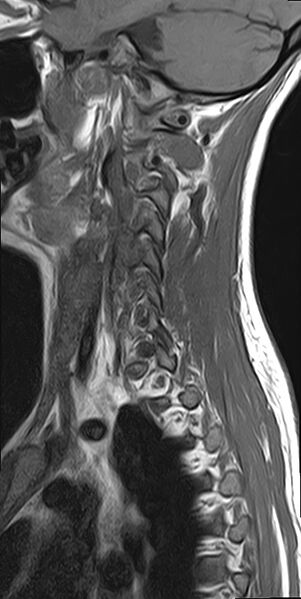 File:Cervical spondylodiscitis and calvarial hemangioma (Radiopaedia 64317-73104 Sagittal T1 2).jpg