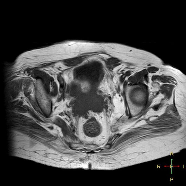 File:Cervical stump squamous cell carcinoma (Radiopaedia 48049-52858 Axial T1 10).jpg