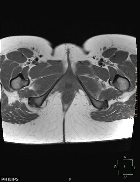 File:Cesarian scar endometriosis (Radiopaedia 68495-78066 Axial T1 27).jpg