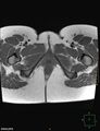 Cesarian scar endometriosis (Radiopaedia 68495-78066 Axial T1 27).jpg
