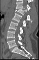 Chance fracture (Radiopaedia 11293-11657 Sagittal bone window 1).jpg