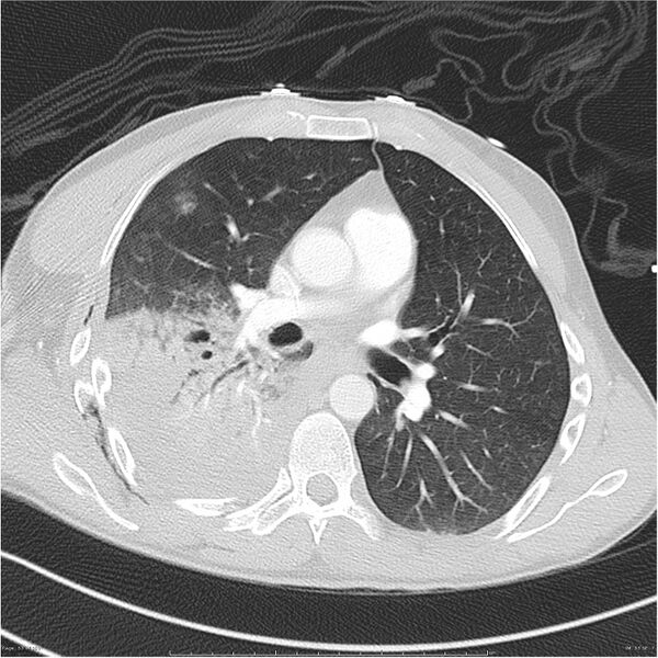 File:Chest and abdomen multi-trauma (Radiopaedia 26294-26425 lung window 53).jpg