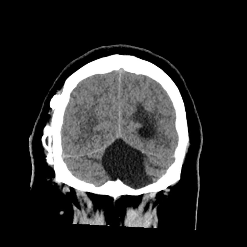 Chiasmatic-hypothalamic juvenile pilocytic astrocytoma (Radiopaedia 78533-91237 Coronal non-contrast 59).jpg