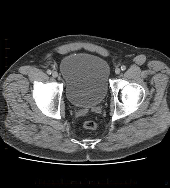 File:Chicken bone in anal canal (Radiopaedia 51490-57253 Axial non-contrast 2).jpg