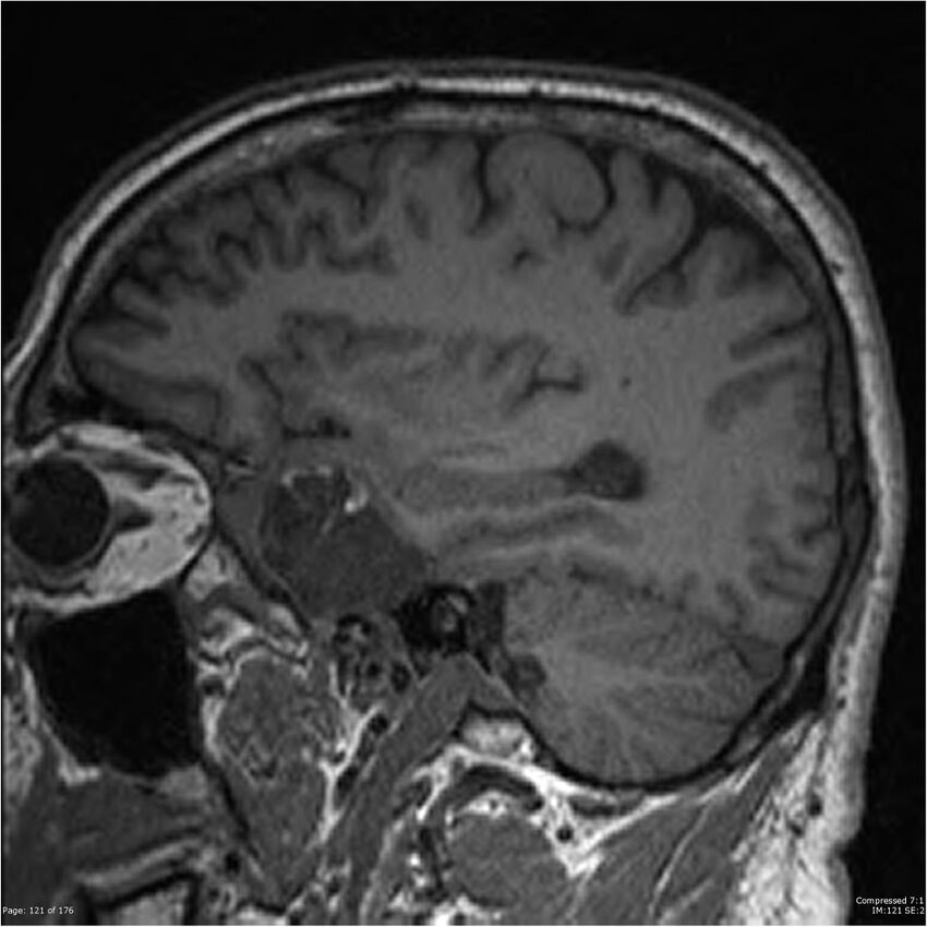 Chondrosarcoma of skull base- grade II (Radiopaedia 40948-43654 Sagittal T1 44).jpg