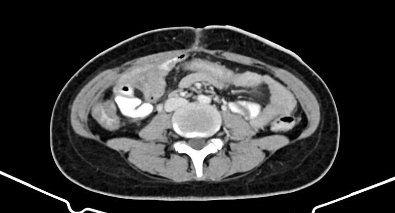 File:Choriocarcinoma liver metastases (Radiopaedia 74768-85766 A 125).jpg