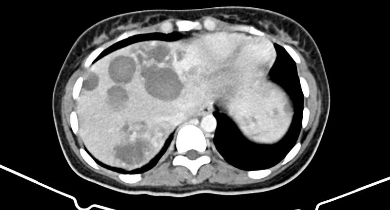 File:Choriocarcinoma liver metastases (Radiopaedia 74768-85766 A 30).jpg