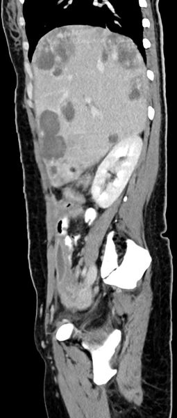 File:Choriocarcinoma liver metastases (Radiopaedia 74768-85766 C 122).jpg
