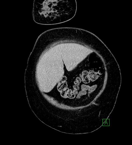 File:Chromophobe renal cell carcinoma (Radiopaedia 84239-99519 F 12).jpg