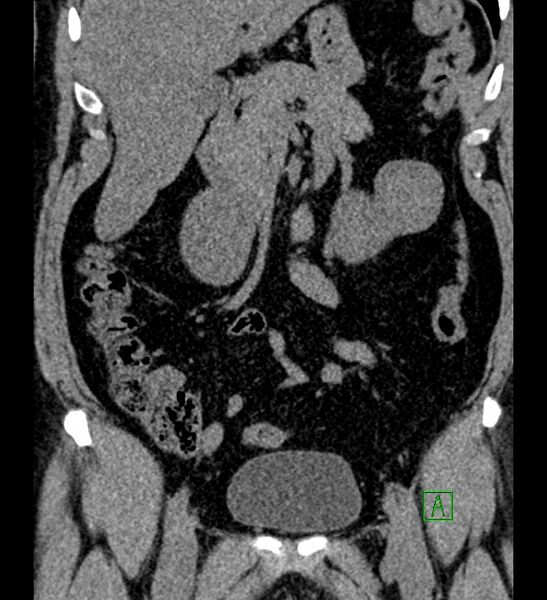 File:Chromophobe renal cell carcinoma (Radiopaedia 84286-99573 Coronal non-contrast 72).jpg