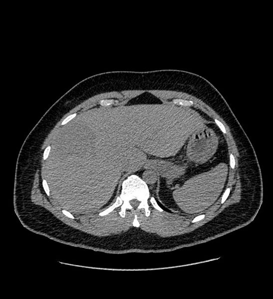 File:Chromophobe renal cell carcinoma (Radiopaedia 84337-99693 Axial non-contrast 17).jpg