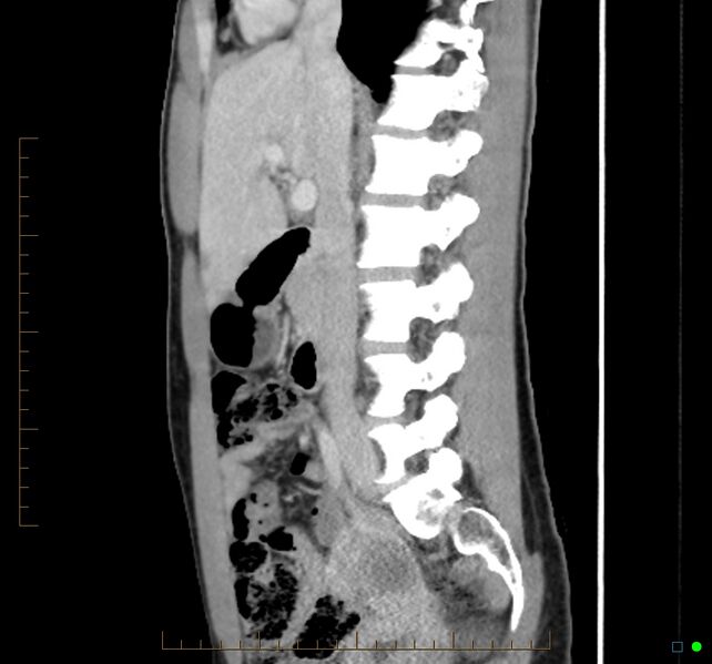 File:Chronic abscess due to "dropped" appendicoliths following appendectomy for perforated appendix (Radiopaedia 58805-66344 D 33).jpg