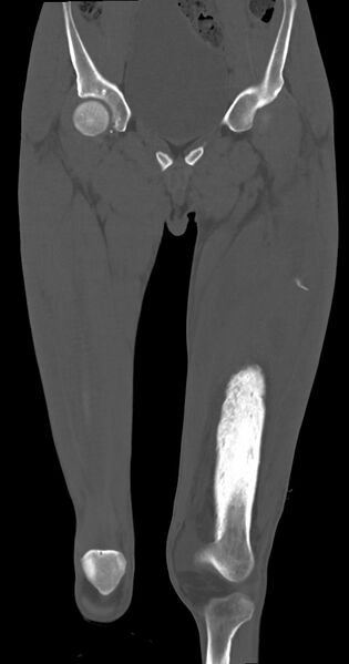 File:Chronic osteomyelitis (with sequestrum) (Radiopaedia 74813-85822 Coronal non-contrast 19).jpg