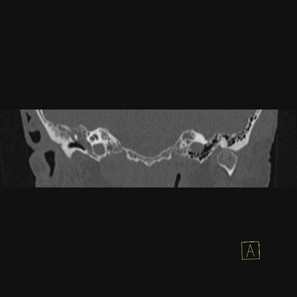 File:Chronic otitis media (Radiopaedia 14994-14912 Coronal bone window 15).JPEG