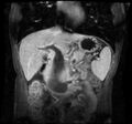 Chronic pancreatitis (Radiopaedia 11313-11677 E 1).jpg