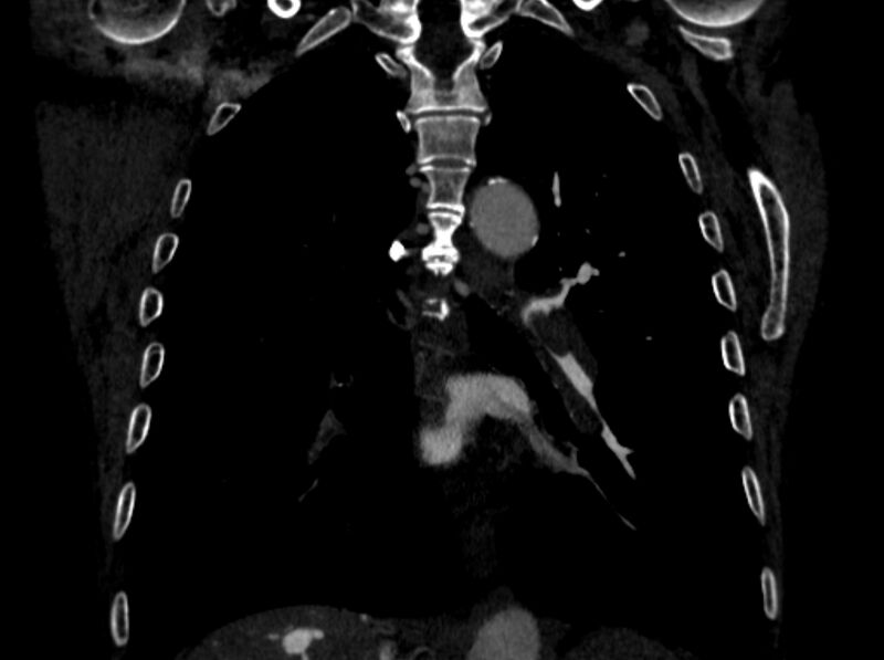 File:Chronic pulmonary embolism (Radiopaedia 91241-108843 A 69).jpg