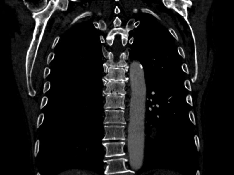 File:Chronic pulmonary embolism (Radiopaedia 91241-108843 A 85).jpg