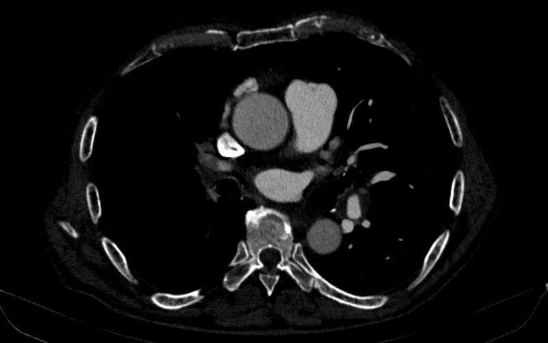 File:Chronic pulmonary embolism (Radiopaedia 91241-108843 B 97).jpg