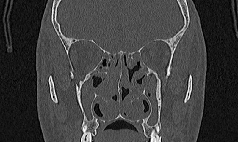 File:Chronic rhinosinusitis (Radiopaedia 65079-74075 Coronal bone window 44).jpg