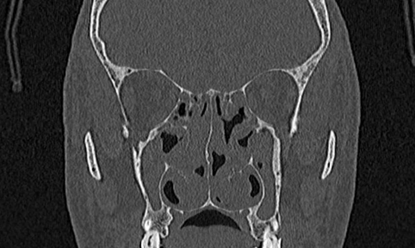 Chronic rhinosinusitis (Radiopaedia 65079-74075 Coronal bone window 44).jpg