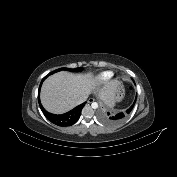 File:Chronic thromboembolic pulmonary hypertension (CTEPH) (Radiopaedia 74597-85532 Axial C+ CTPA 36).jpg