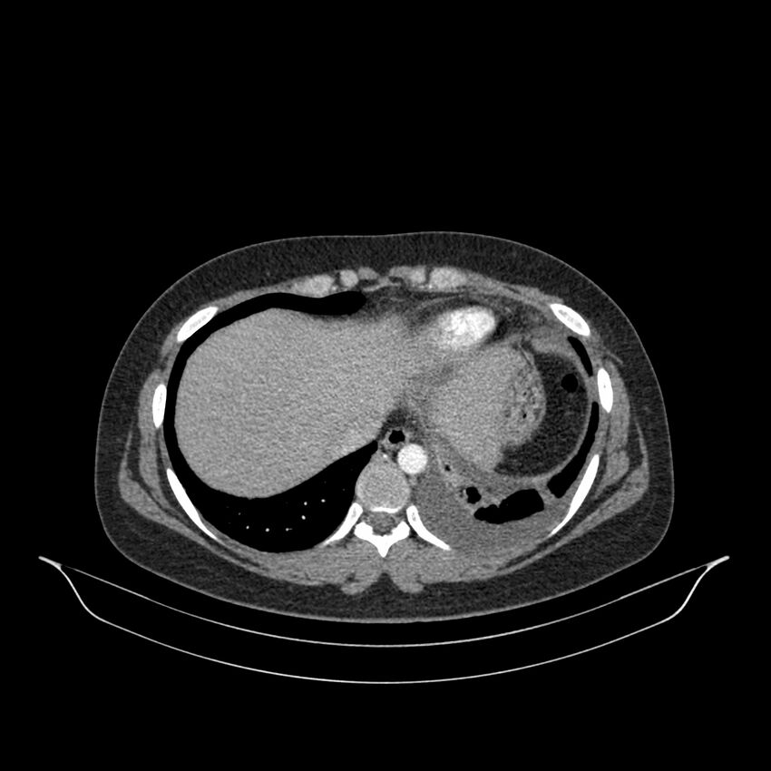 Chronic thromboembolic pulmonary hypertension (CTEPH) (Radiopaedia 74597-85532 Axial C+ CTPA 36).jpg