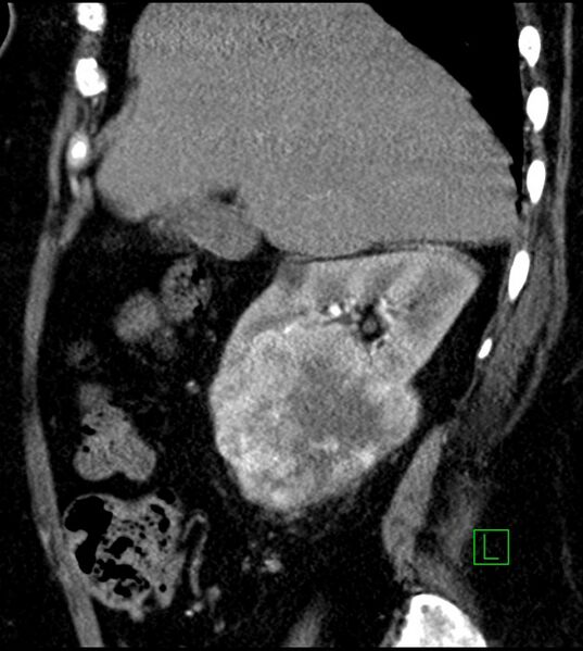File:Clear cell renal cell carcinoma (Radiopaedia 85004-100537 D 45).jpg