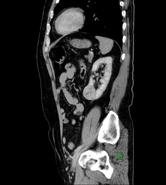 File:Clear cell renal cell carcinoma (Radiopaedia 85006-100539 G 18).jpg