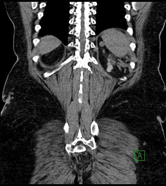 File:Closed-loop small bowel obstruction-internal hernia (Radiopaedia 78439-91096 Coronal non-contrast 85).jpg
