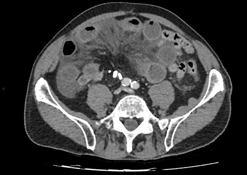 File:Closed loop small bowel obstruction with ischemia (Radiopaedia 84180-99456 A 79).jpg