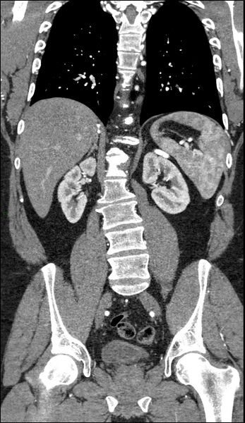 File:Coarctation of the aorta (Radiopaedia 74632-88521 B 156).jpg