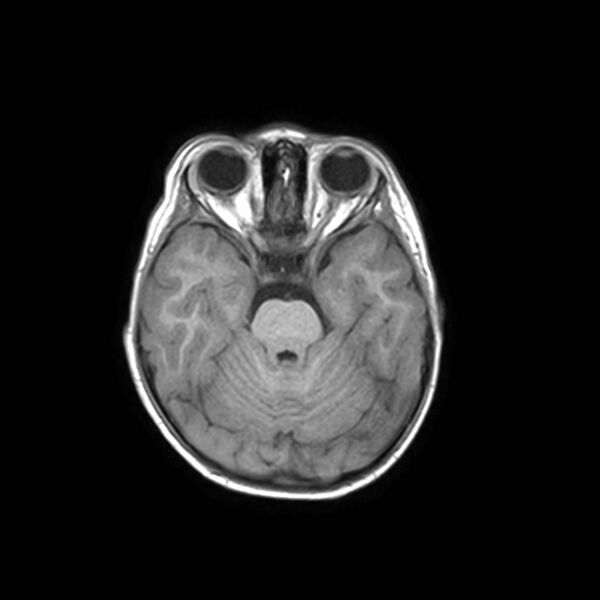 File:Cochlear nerve aplasia - unilateral (Radiopaedia 87910-104413 Axial T1 14).jpg