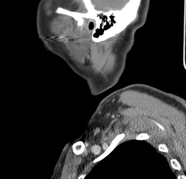File:Colloid cyst of thyroid (Radiopaedia 22897-22923 Sagittal C+ delayed 52).jpg