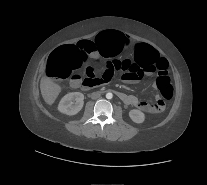 File:Colonic pseudo-obstruction (Radiopaedia 79752-92980 A 91).png