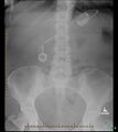 Disconnected gastric band tubing and small bowel obstruction (Radiopaedia 62945).jpg