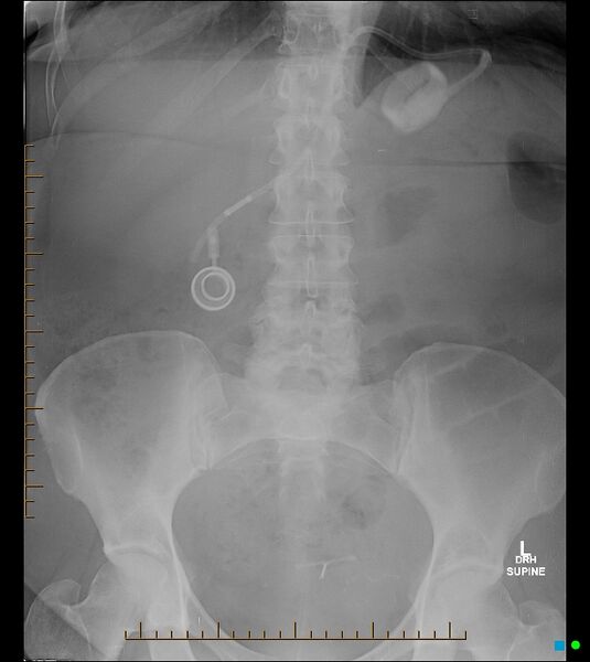 File:Disconnected gastric band tubing and small bowel obstruction (Radiopaedia 62945).jpg