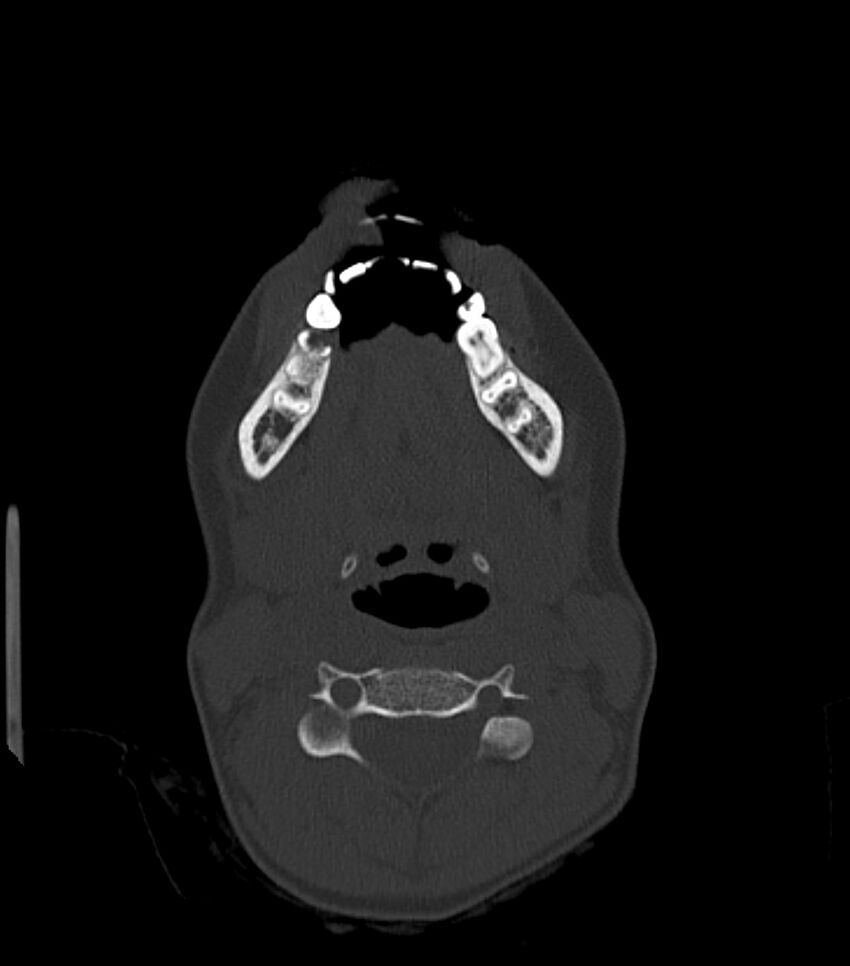 Nasoorbitoethmoid fracture (Radiopaedia 90044-107205 Axial bone window 29).jpg