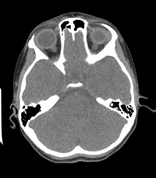 File:Nasoorbitoethmoid fracture (Radiopaedia 90044-107205 Axial non-contrast 172).jpg