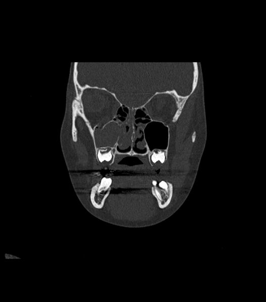 File:Nasoorbitoethmoid fracture (Radiopaedia 90044-107205 Coronal bone window 53).jpg