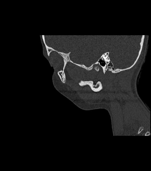 File:Nasoorbitoethmoid fracture (Radiopaedia 90044-107205 Sagittal bone window 36).jpg