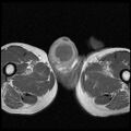 Necrotizing epididymo-orchitis with intra-testicular abscess (Radiopaedia 29397-29860 Axial T1 C+ 14).jpg