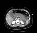 Necrotizing pancreatitis (Radiopaedia 23001-23031 A 24).jpg
