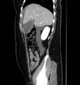 Necrotizing pancreatitis (Radiopaedia 23001-23031 C 17).jpg